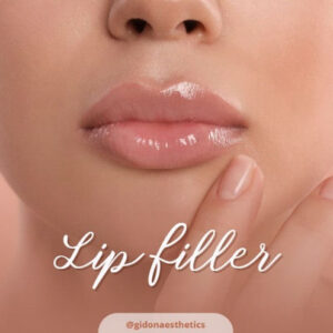 lip filler